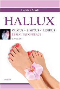 Hallux - Řešení bez operace