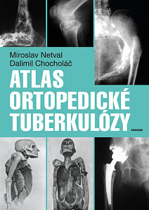 E-kniha Atlas ortopedické tuberkulózy
